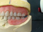 Figure 8  Left posterior interocclusal space after the occlusal record has been removed.
