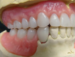 Figure 16  Right posterior view of lingualized occlusion after resetting denture teeth to instructions on Rx. Note the vertical overlap of the anteriors and visualize if the mandibular incisal edges were 1 mm shorter.