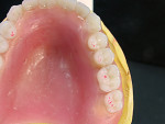 Figure 19 Occlusal view of the mandibular anterior crowns and posterior denture teeth showing ridge and cusp tip relationship. Note the incisal edges of Nos. 23 through 26 are slightly labial to canines. They should be brought back 1 mm lingual as well.