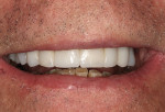 Figure 4 Close-up view of the Radica provisional restorations with the patient in natural smile.