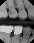 Figure 1 An extensive radiographic carious lesion on the distal aspect of tooth No. 4