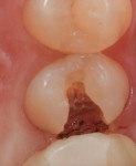 Figure 4 The carious penetration in the central groove was “opened up” using a Fissurotomy bur to gain conservative access to the active lesion below.