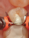 Figure 6 A sectional matrix (Garrison 3-D, Garrison Dental Solutions) and a bioactive cavity liner (TheraCal LC, Bisco) were placed.