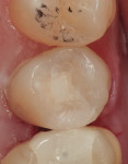 Figure 8 The completed composite restoration on tooth No. 4 after instrumentation with the Comfortable Cavity Prep System.