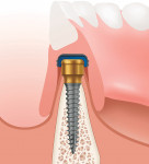 Figure 1 The LODI System is a less-invasive, predictable, and durable implant-retained option for overdenture restorations with a dramatically reduced vertical height compared to 0-ball mini implants.