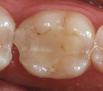 Figure 2  Preoperative clinical condition of tooth No. 19 with fractured distal marginal ridge.
