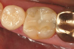 Figure 5   Preoperative clinical condition of tooth No. 30 with undermined lingual cusps.