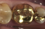 Figure 8  Preoperative clinical condition of a gold crown with a perforation in the occlusal surface enrolled in the clinical study on e.max CAD crowns.