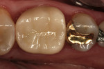Figure 9   Cemented IPS e.max CAD crown at baseline evaluation.