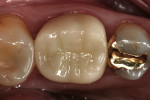 Figure 10  IPS e.max CAD crown No. 19 at 2-year recall evaluation (Fig 10), and at 4-year recall evaluation (Fig 11).