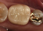 Figure 11  IPS e.max CAD crown No. 19 at 2-year recall evaluation (Fig 10), and at 4-year recall evaluation (Fig 11).