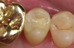 Figure 12  Evaluation of Paradigm MZ100 inlay on tooth No. 13 at 2-year recall (Fig 12), 6-year recall (Fig 13), and 10-year recall (Fig 14).