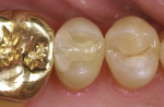 Figure 13  Evaluation of Paradigm MZ100 inlay on tooth No. 13 at 2-year recall (Fig 12), 6-year recall (Fig 13), and 10-year recall (Fig 14).