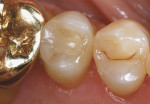 Figure 14  Evaluation of Paradigm MZ100 inlay on tooth No. 13 at 2-year recall (Fig 12), 6-year recall (Fig 13), and 10-year recall (Fig 14).