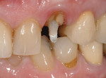 Figure 9  An existing crown and core build-up material on tooth No. 11 had debonded from the fiber-reinforced dowel. Remaining tooth structure provided adequate ferrule to new core and restoration.