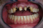 Figure 14 Posterior bite and vertical dimension were established before restoring the maxillary.