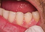 Figure 22 The minimal-preparation design of the lower first premolars.