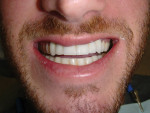 Figure 4 The patient desired to have a longer, fuller smile with a normal overbite.
