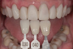 Figure 5 A photograph with shade tabs communicated the desired color of the final restorations to the laboratory.