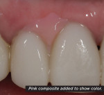 Figure 7 A gingival deficiency between teeth Nos. 7 and 8 required the use of pink ceramic. A pink composite piece was fabricated chairside to communicate the color and size of the desired papilla.