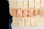 Figure 11 and Figure 12 A silicone matrix of the provisional restorations was placed on the working model and a wax injection process was used to transfer the shape, form, and position of the provisional restorations to the final wax-up. The injection was then refined to achieve the final full-contour wax-up.