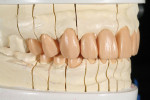 Figure 11 and Figure 12 A silicone matrix of the provisional restorations was placed on the working model and a wax injection process was used to transfer the shape, form, and position of the provisional restorations to the final wax-up. The injection was then refined to achieve the final full-contour wax-up.