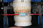 Figure 10 The stick bite was used to verify the vertical midline of the initial wax injection.