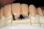 Figure 21 The incisal area was cut back to allow room for micro-layering of the incisors.