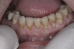 Figure 1 - A 58-year-old patient was found to have carious lesions and erosion on teeth Nos. 21 through 27.