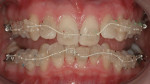 Figure 3 - Retracted anterior view during the braces placement appointment.