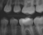 Figure 4 - The final radiograph, showing the sealant adaption on the first molar.