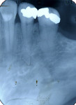 Figure 3  Cervical inflammatory resorption of lower left first bicuspid (Fig 2); preoperative radiographs using MBD rule (Fig 3). Note how resorption extends to root surface.