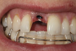 Figure 1 - The zirconia abutment for tooth No. 8.