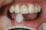 Figure 2 - A GC shade tab was used to match the incisal one third.