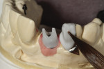 Figure 4 - Porcelain application on tooth No. 7.