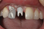 Figure 5 - Layered enamel on top of the foil in the patient’s mouth.