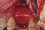 Figure 10 The Guidor barrier was extended to cover the labial graft extending to the palate.