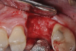 Figure 12 Re-entering the site at 26 weeks, robust bone formation had occurred and a 4.8-mm-wide implant was placed.