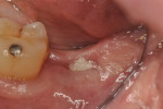 Figure 16 At 8 weeks following extraction, the barrier was still partially intact over the socket; there was minimal inflammation of the tissue next to the barrier.