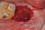 Figure 13 This 69-year-old osteoporotic female’s mandibular left second molar was extracted due to untreatable subcrestal caries. The extraction socket had thick bone walls and was intact.