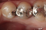 Figure 1 Preoperative photograph of failing amalgam restorations on premolars.