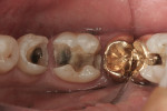 Figure 9 The old amalgam and recurrent decay were removed.