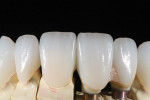 Figure 7 High translucency IPS e.max restorations were made over abutments and natural teeth.