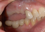 Manufacturing Snap-On Smiles for Functional and Cosmetic Restorative Solutions Webinar Thumbnail
