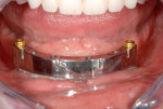 Figure 15 Final implant-retained milled titanium bar with attachments.