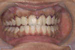 Figure 8. Retracted view showing proposed gingival levels marked with surgical marker.