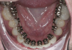 Figure 6. The patient’s lower arch with Incognito lingual braces in place.