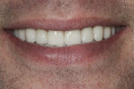 Figure 15. Reverse smile line was corrected
with final porcelain restorations.