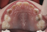 Figure 1 Maxillary teeth of a 3-year-old girl with multiple caries lesions of varying severity.