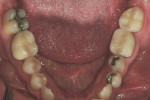 Figure 1The patient presented with a chipped layered zirconia crown on tooth No. 18.